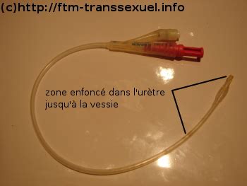 bander avec une sonde urinaire|Relation avec une sonde jj